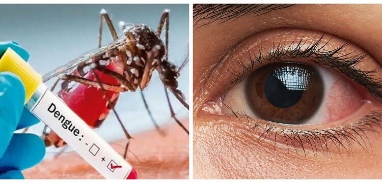 हाेशियार ! देशभर फैलिदै डेङ्गी र आँखा पाक्ने सङ्क्रमण फैलिँदै