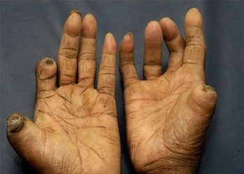आँखाले देख्न नसकिने रोग